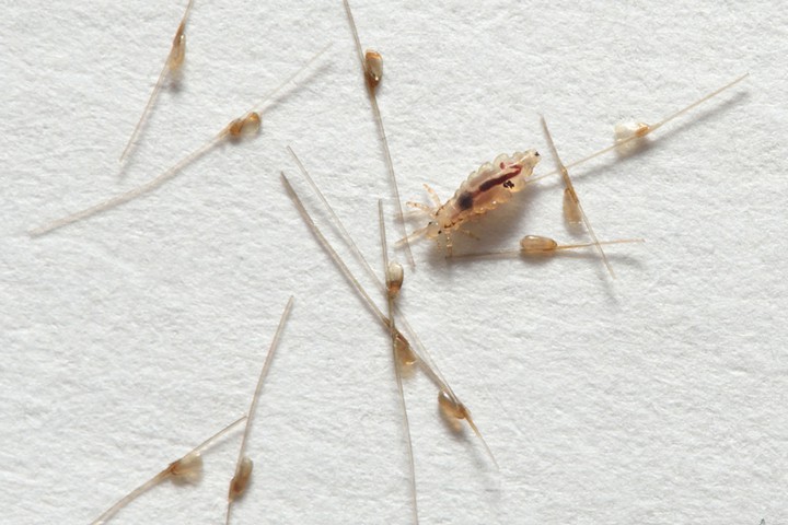 a louse full of blood and lice eggs attached to hair