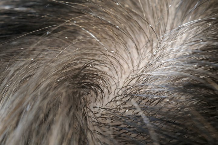 lice eggs attached to hair near scalp
