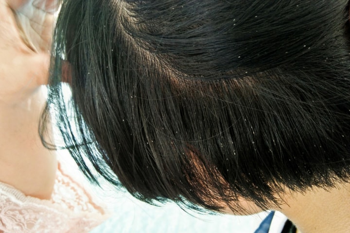 lice spread around hair up close